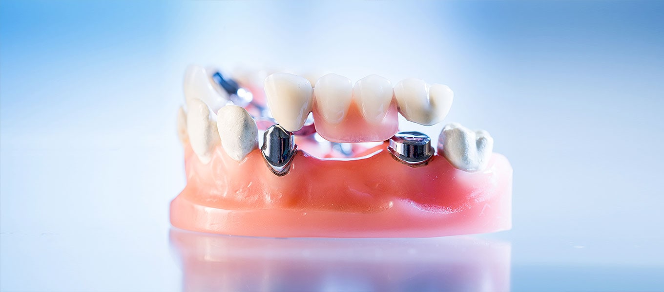 Ohne zahnersatz gaumenplatte oberkiefer highclenovfan: Zahnprothese