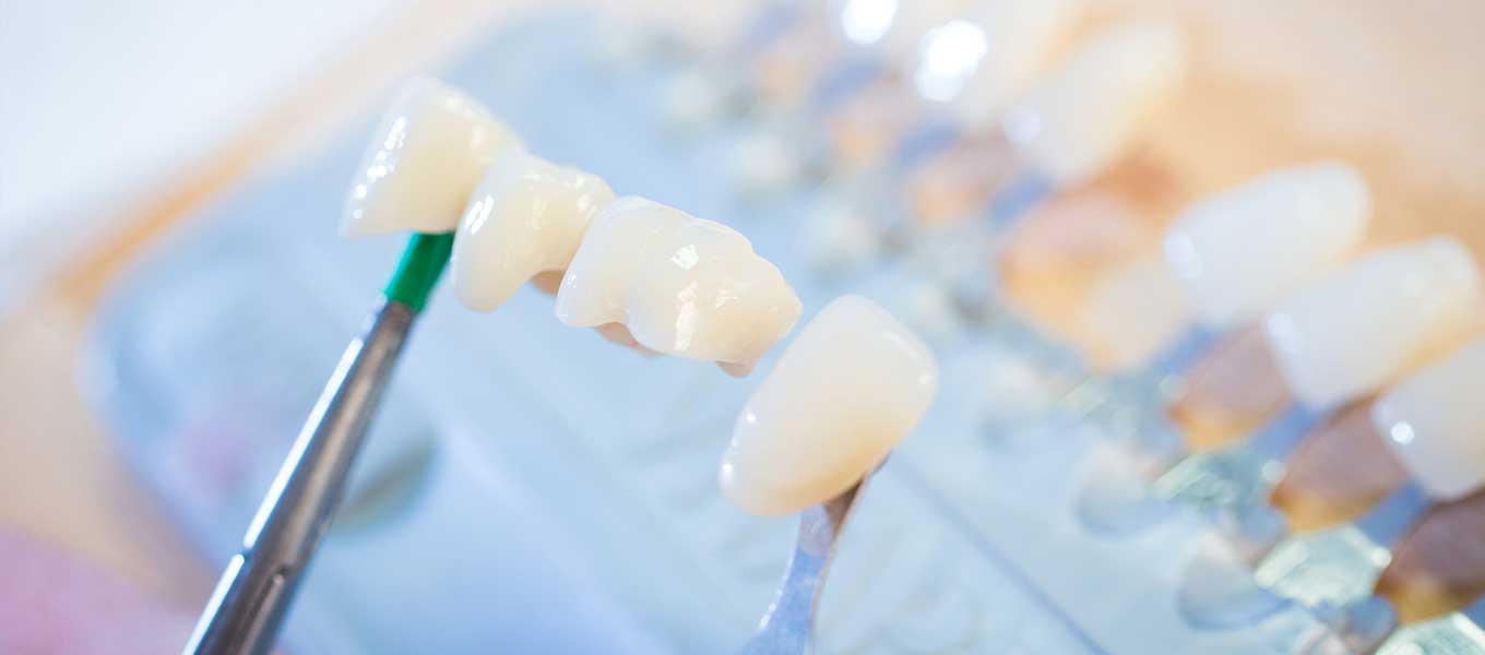 DentNet Ratgeber - Bestimmung der Zahnfarbe