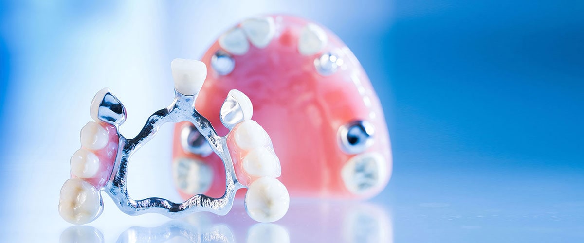 Zahnimplantate – medizinische Notwendigkeit, Risiken und Kosten – Erfahren Sie mehr