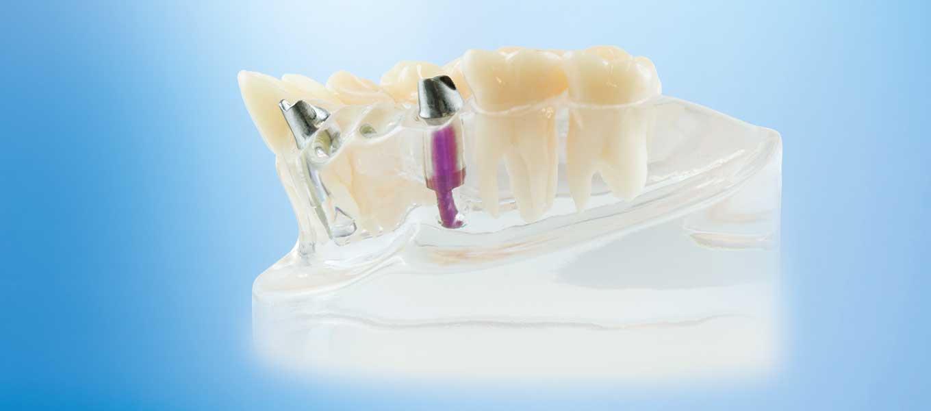 Individuelle Aufbauten Abutment Implantation