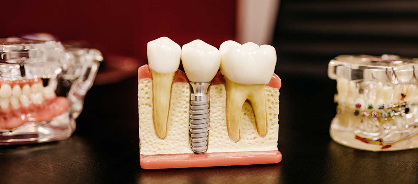 DentNet Ratgeber - festsitzender Zahnersatz