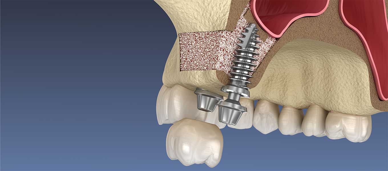 DentNet Ratgber - Sinuslift Implantate