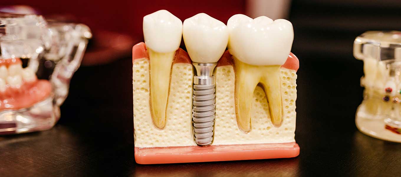 DentNet Ratgeber - Implantatschraube im Modell