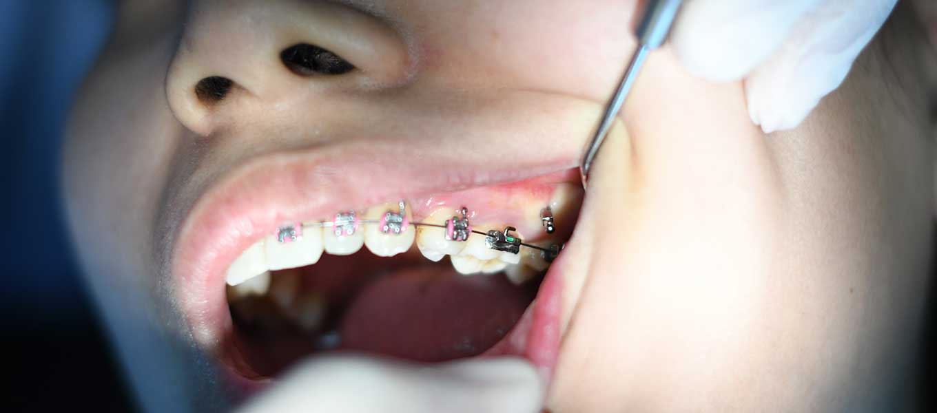 DentNet Ratgeber - festsitzende Zahnspange