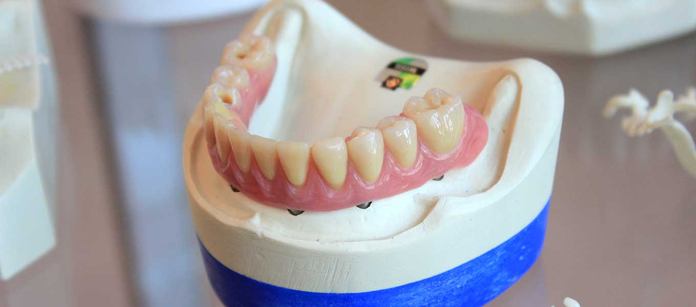 DentNet Ratgeber - All-on-4 Zahnimplantate 2