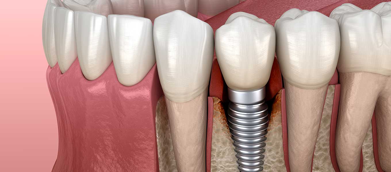 DentNet Ratgeber - Periimplantitis – Entzündung des Implantatbetts