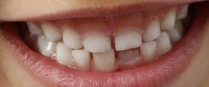 DentNet Ratgeber - Zahnschmerzen - Kinderzähne - Milchzähne - Kind