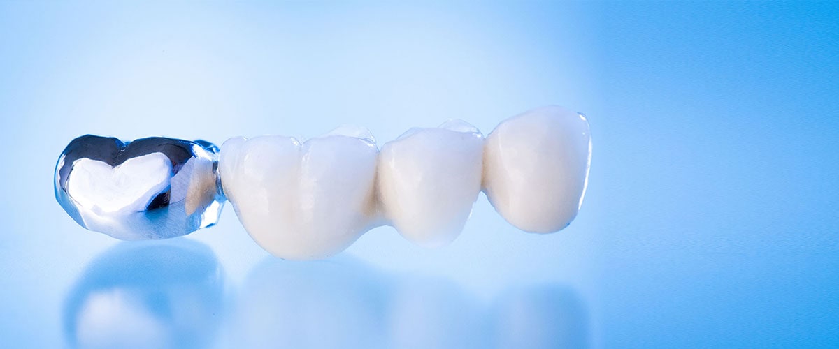 DentNet Ratgeber - Zahnersatz im DentNet