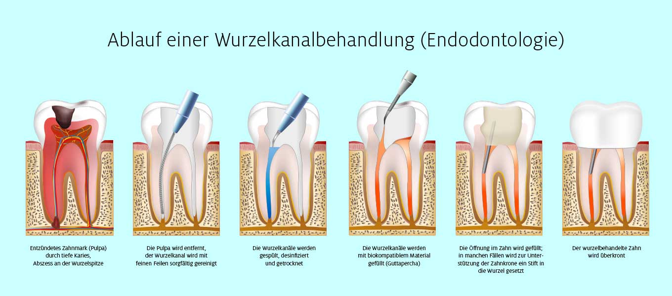 DentNet Ratgeber – Wurzelkanalbehandlung – Wurzelbehandlung